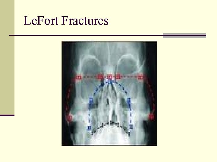 Le. Fort Fractures 