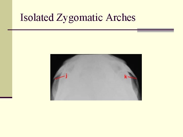Isolated Zygomatic Arches 