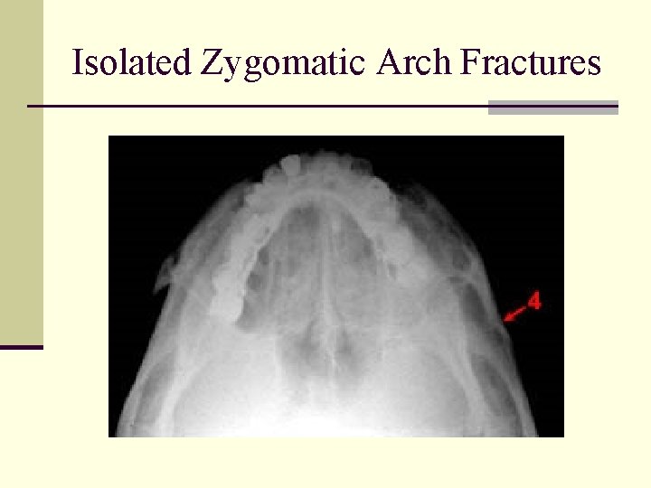 Isolated Zygomatic Arch Fractures 