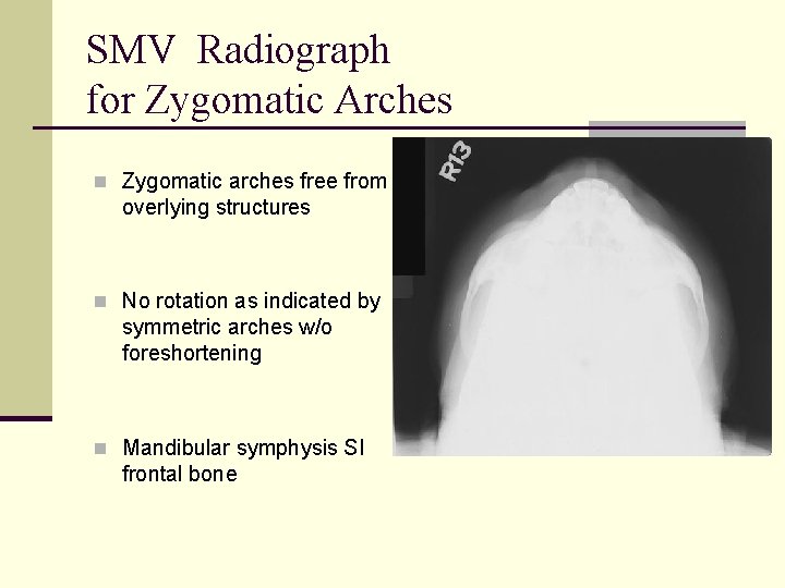 SMV Radiograph for Zygomatic Arches n Zygomatic arches free from overlying structures n No