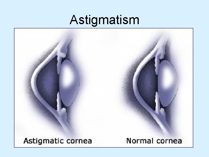 Astigmatism 