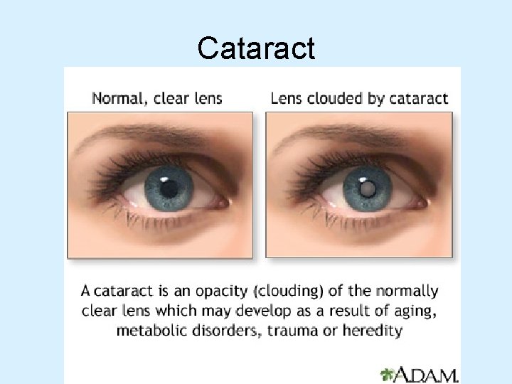 Cataract 