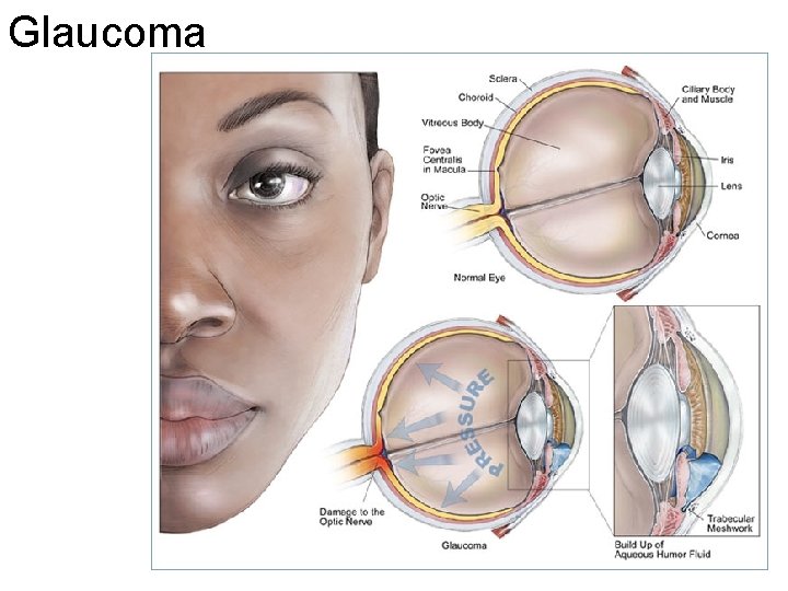 Glaucoma 