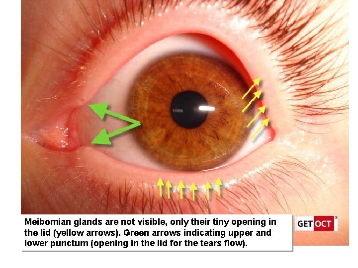 Meibomian glands are not visible, only their tiny opening in the lid (yellow arrows).