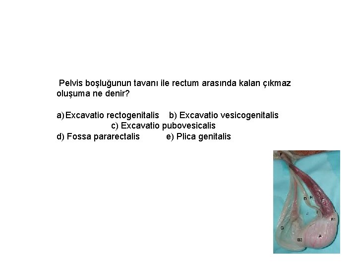 Pelvis boşluğunun tavanı ile rectum arasında kalan çıkmaz oluşuma ne denir? a) Excavatio rectogenitalis