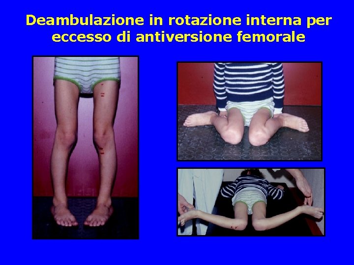 Deambulazione in rotazione interna per eccesso di antiversione femorale Deambulazione in rotazione interna per eccesso di antiversione femorale