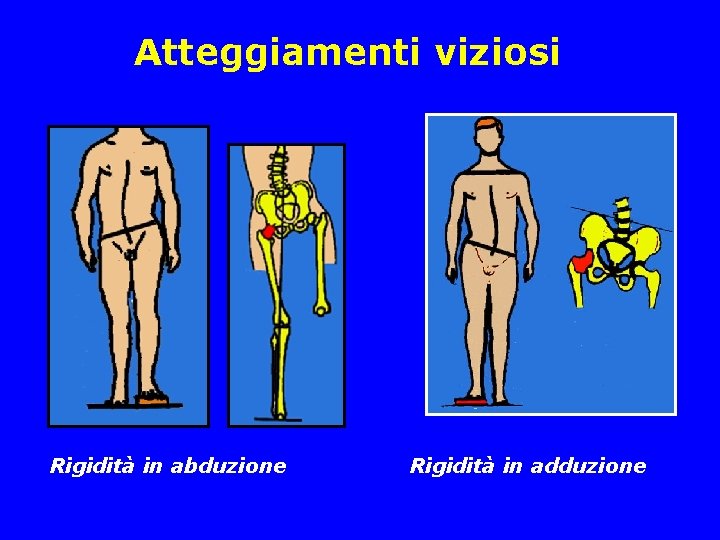Atteggiamenti viziosi Rigidità in abduzione Rigidità in adduzione Atteggiamenti viziosi Rigidità in abduzione Rigidità in adduzione