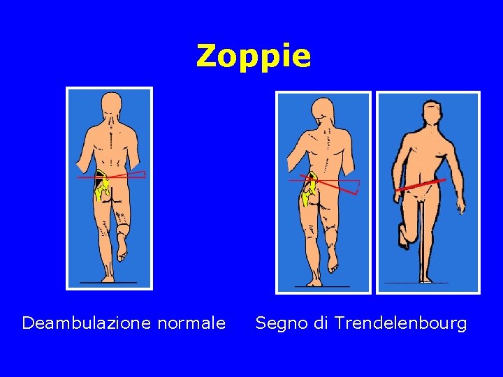 Zoppie Deambulazione normale Segno di Trendelenbourg Zoppie Deambulazione normale Segno di Trendelenbourg