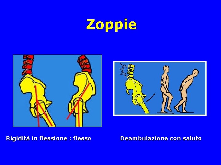 Zoppie Rigidità in flessione : flesso Deambulazione con saluto Zoppie Rigidità in flessione : flesso Deambulazione con saluto
