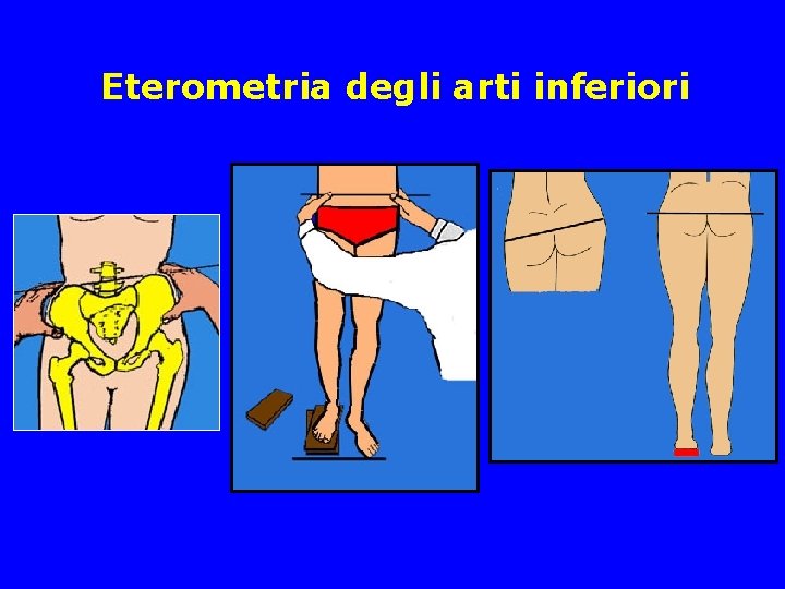 Eterometria degli arti inferiori Eterometria degli arti inferiori