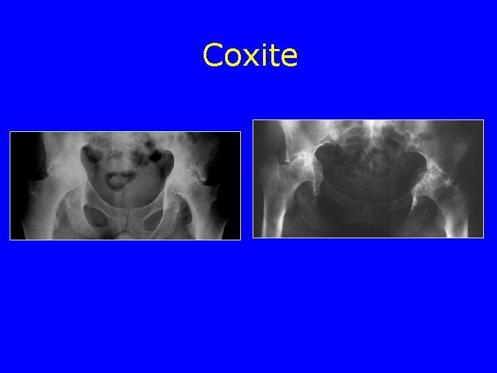 Coxite Coxite