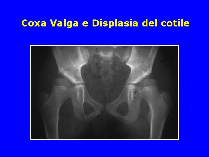 Coxa Valga e Displasia del cotile Coxa Valga e Displasia del cotile