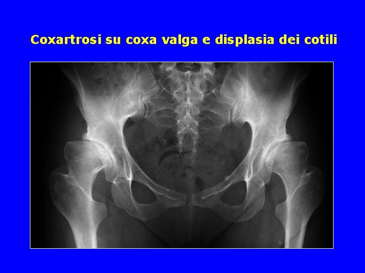 Coxartrosi su coxa valga e displasia dei cotili Coxartrosi su coxa valga e displasia dei cotili