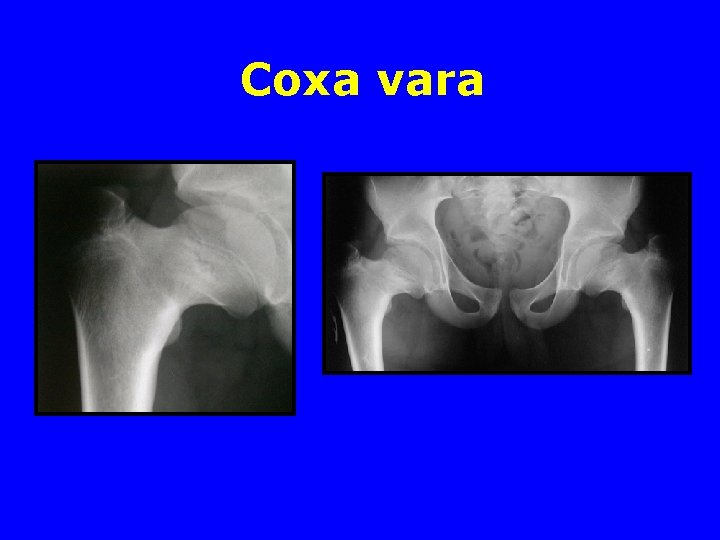 Coxa vara Coxa vara