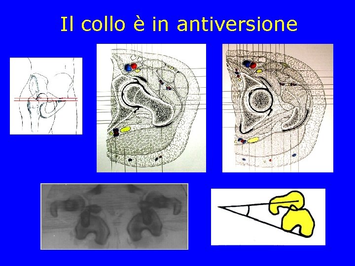 Il collo è in antiversione Il collo è in antiversione