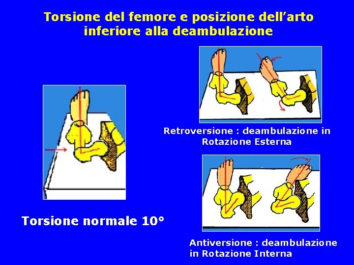 Torsione del femore e posizione dell’arto inferiore alla deambulazione Retroversione : deambulazione in Rotazione Torsione del femore e posizione dell’arto inferiore alla deambulazione Retroversione : deambulazione in Rotazione
