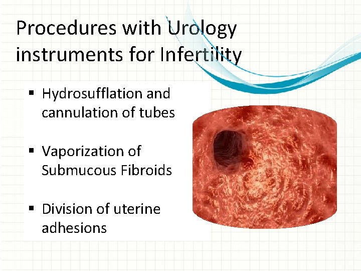 Procedures with Urology instruments for Infertility § Hydrosufflation and cannulation of tubes § Vaporization