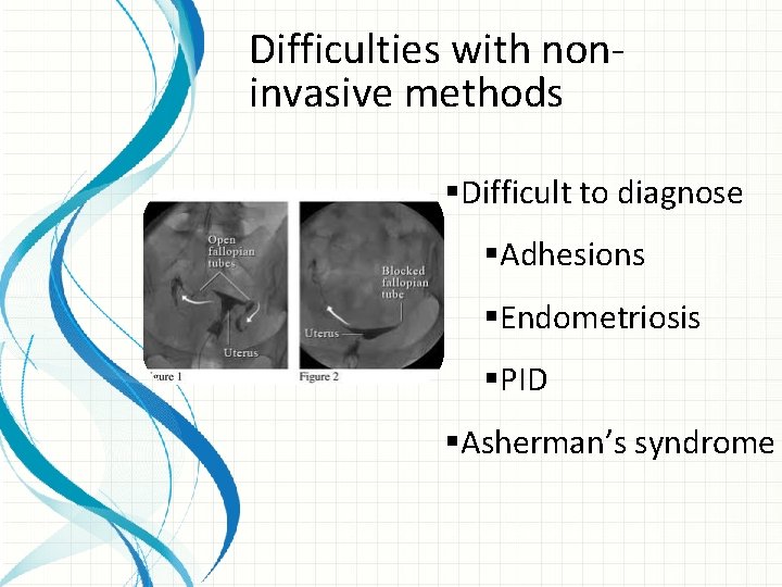 Difficulties with noninvasive methods §Difficult to diagnose §Adhesions §Endometriosis §PID §Asherman’s syndrome 