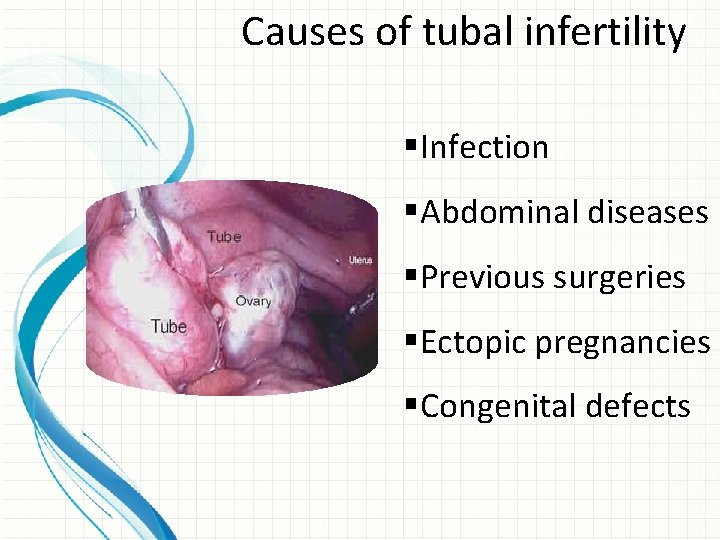 Causes of tubal infertility §Infection §Abdominal diseases §Previous surgeries §Ectopic pregnancies §Congenital defects 