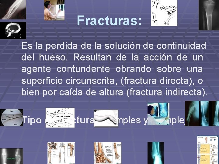 Fracturas: Es la perdida de la solución de continuidad del hueso. Resultan de la Fracturas: Es la perdida de la solución de continuidad del hueso. Resultan de la