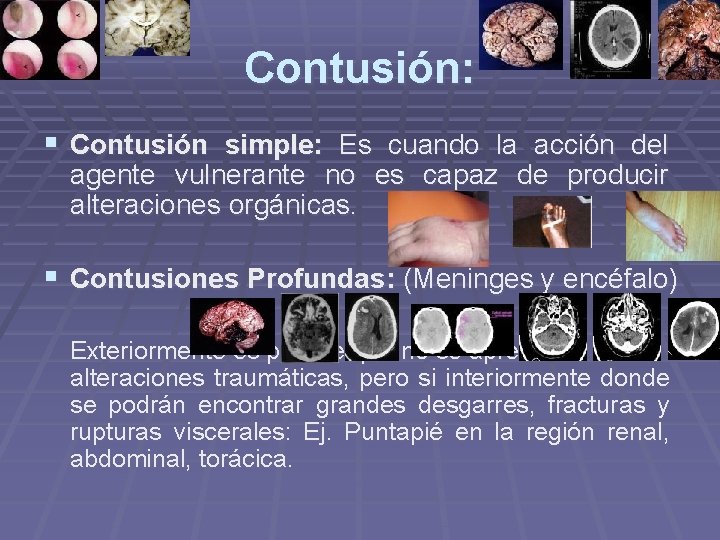 Contusión: § Contusión simple: Es cuando la acción del agente vulnerante no es capaz Contusión: § Contusión simple: Es cuando la acción del agente vulnerante no es capaz