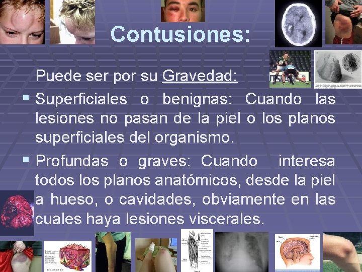 Contusiones: Puede ser por su Gravedad: § Superficiales o benignas: Cuando las lesiones no Contusiones: Puede ser por su Gravedad: § Superficiales o benignas: Cuando las lesiones no