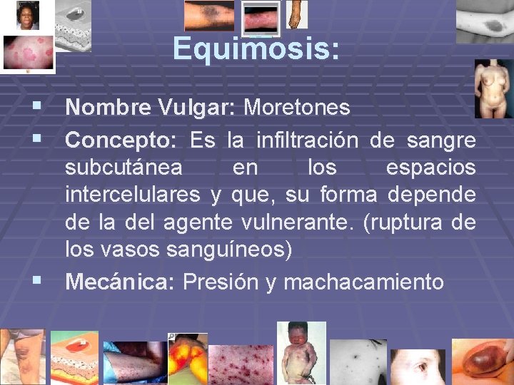 Equimosis: § Nombre Vulgar: Moretones § Concepto: Es la infiltración de sangre subcutánea en Equimosis: § Nombre Vulgar: Moretones § Concepto: Es la infiltración de sangre subcutánea en