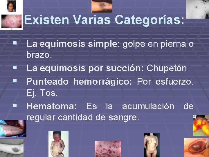 Existen Varias Categorías: § La equimosis simple: golpe en pierna o § § § Existen Varias Categorías: § La equimosis simple: golpe en pierna o § § §