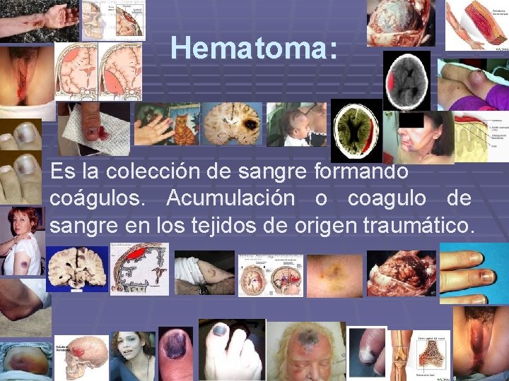 Hematoma: Es la colección de sangre formando coágulos. Acumulación o coagulo de sangre en Hematoma: Es la colección de sangre formando coágulos. Acumulación o coagulo de sangre en