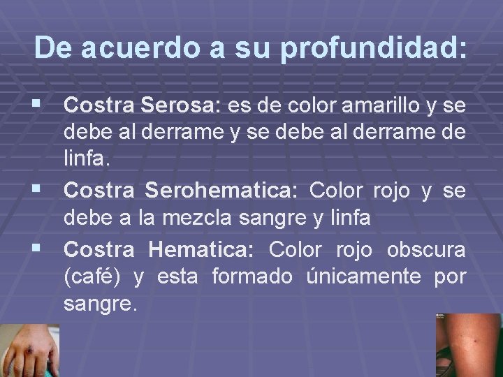 De acuerdo a su profundidad: § Costra Serosa: es de color amarillo y se De acuerdo a su profundidad: § Costra Serosa: es de color amarillo y se