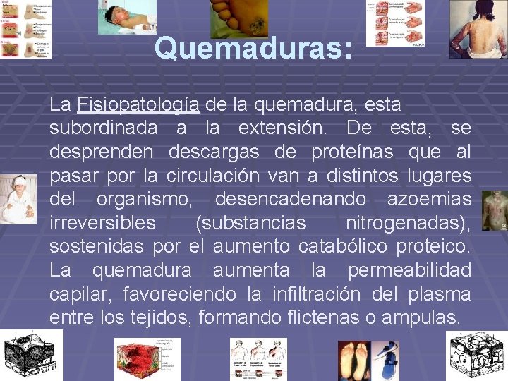Quemaduras: La Fisiopatología de la quemadura, esta subordinada a la extensión. De esta, se Quemaduras: La Fisiopatología de la quemadura, esta subordinada a la extensión. De esta, se