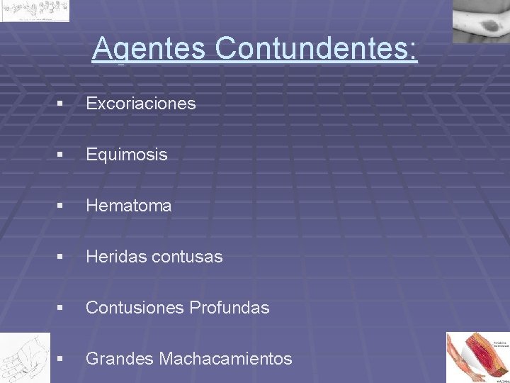 Agentes Contundentes: § Excoriaciones § Equimosis § Hematoma § Heridas contusas § Contusiones Profundas Agentes Contundentes: § Excoriaciones § Equimosis § Hematoma § Heridas contusas § Contusiones Profundas