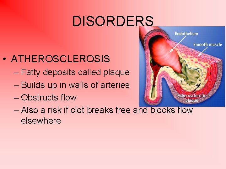 DISORDERS • ATHEROSCLEROSIS – Fatty deposits called plaque – Builds up in walls of