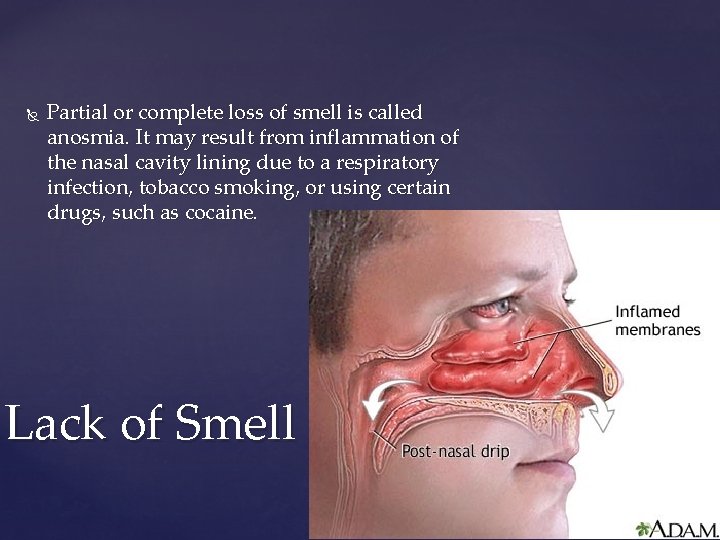  Partial or complete loss of smell is called anosmia. It may result from