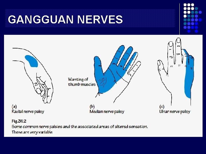 GANGGUAN NERVES 