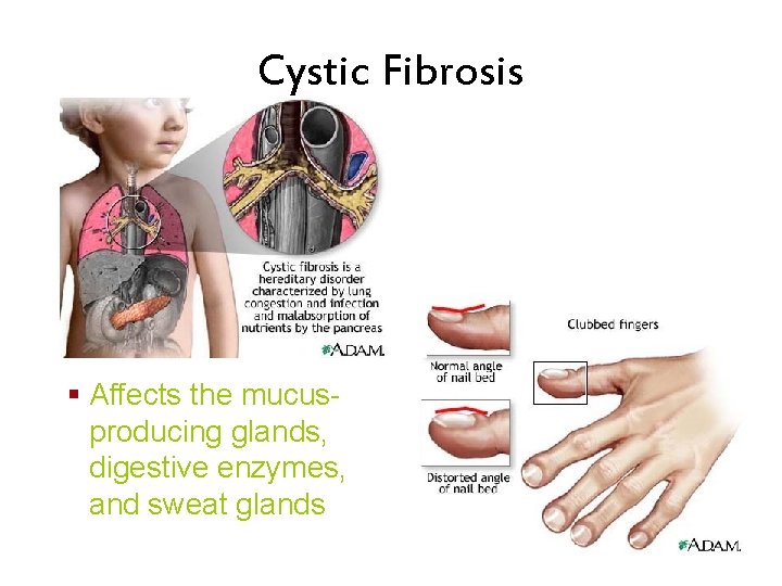 Cystic Fibrosis § Affects the mucusproducing glands, digestive enzymes, and sweat glands 