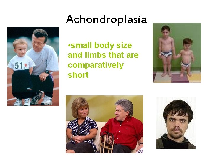 Achondroplasia • small body size and limbs that are comparatively short 