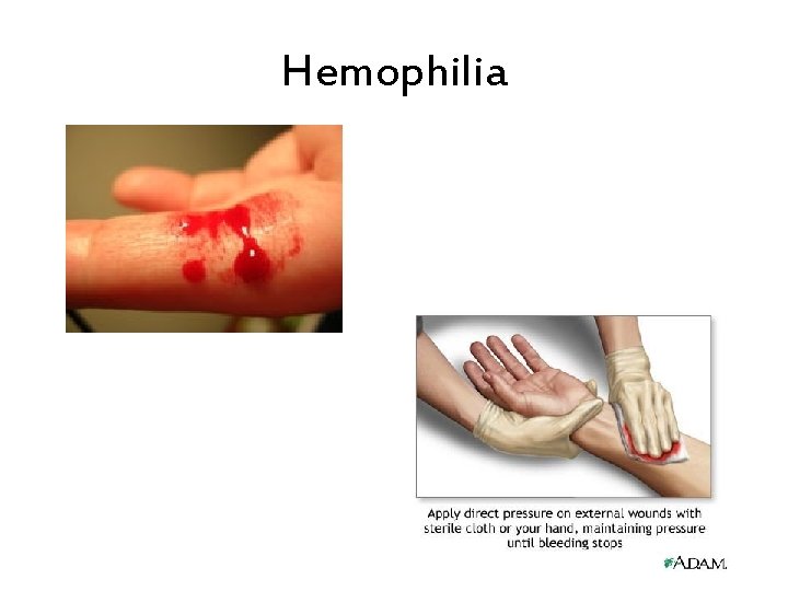 Hemophilia 