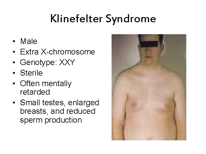 Klinefelter Syndrome • • • Male Extra X-chromosome Genotype: XXY Sterile Often mentally retarded