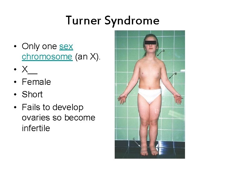 Turner Syndrome • Only one sex chromosome (an X). • X__ • Female •