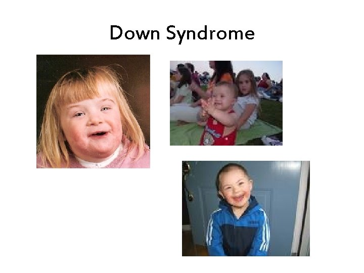 Down Syndrome 