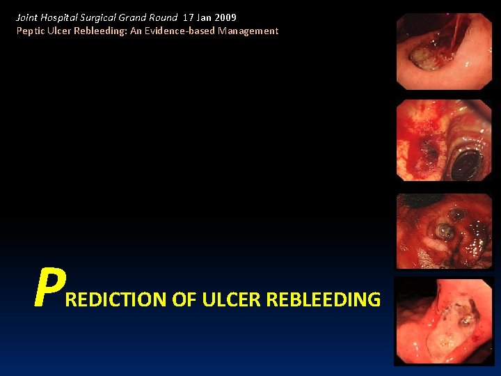 Joint Hospital Surgical Grand Round 17 Jan 2009 Peptic Ulcer Rebleeding: An Evidence-based Management