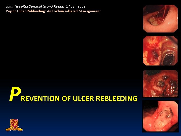 Joint Hospital Surgical Grand Round 17 Jan 2009 Peptic Ulcer Rebleeding: An Evidence-based Management