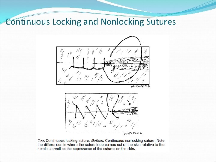 Continuous Locking and Nonlocking Sutures 
