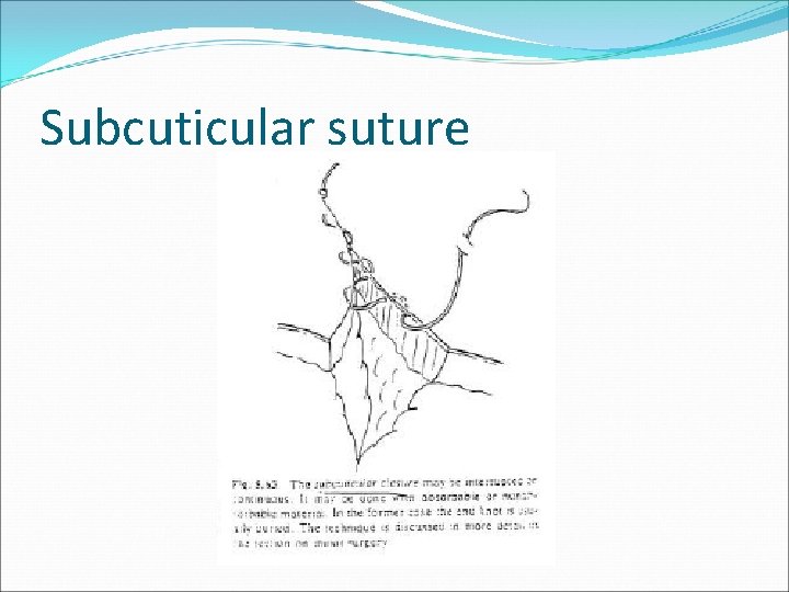 Subcuticular suture 