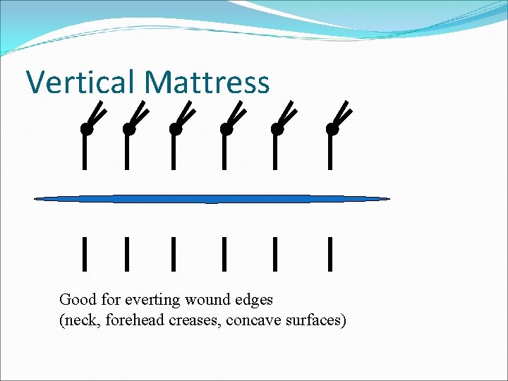 Vertical Mattress Good for everting wound edges (neck, forehead creases, concave surfaces) 