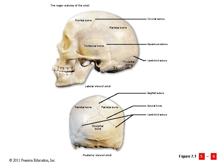 The major sutures of the skull Coronal suture Frontal bone Parietal bone Squamous suture
