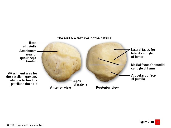 The surface features of the patella Base of patella Attachment area for quadriceps tendon