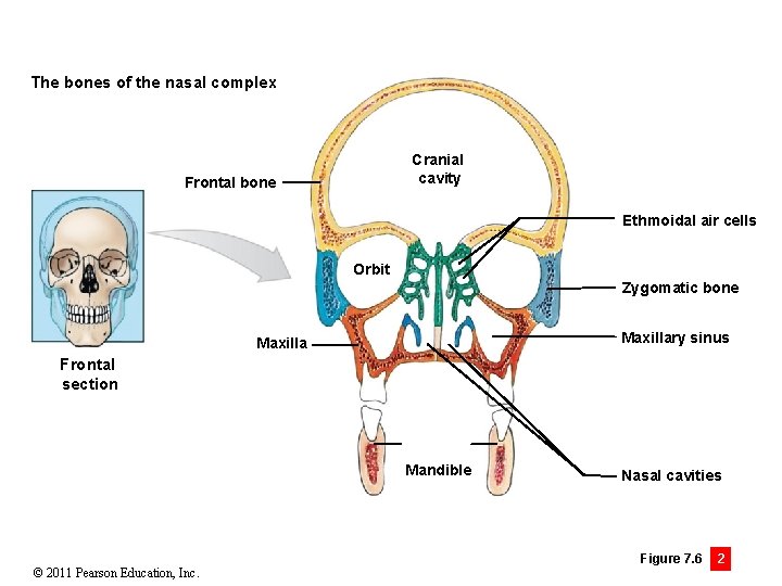 The bones of the nasal complex Cranial cavity Frontal bone Ethmoidal air cells Orbit
