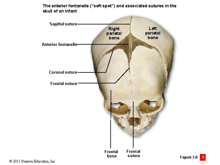 The anterior fontanelle (“soft spot”) and associated sutures in the skull of an infant